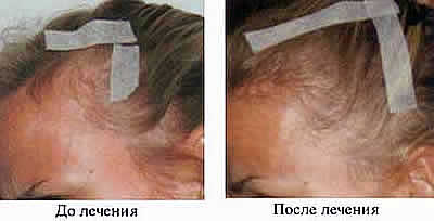 bezinekcionnaja-mezoterapija-derma-oxy-dlja-volos-400